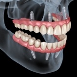 3 D animated smile with dental implant supported denture