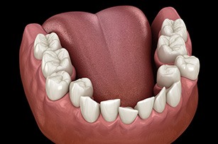 Illustration of crowded teeth